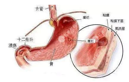 胃健康必备知识：“老胃病”到底能不能拖?