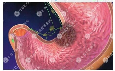 胃健康必备知识：“老胃病”到底能不能拖?